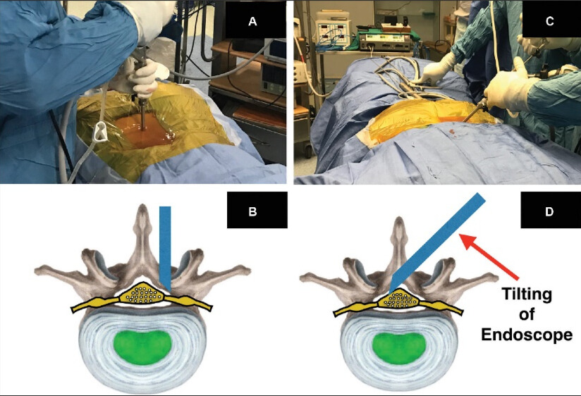 Conditions Treated with Interlaminar Surgery